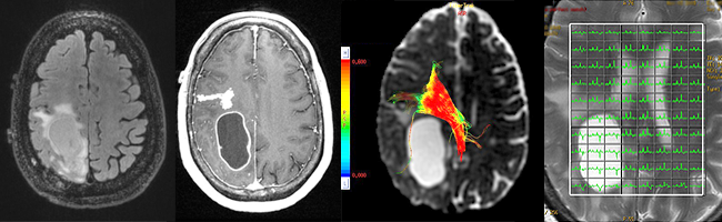 Advanced imaging techniques routinely used by UCSF Neuroradiologists in patients with brain tumors show not only the patient’s brain tumor, but also its relationship to critical white matter tracts around the tumor and the metabolic signature of the tumor, a reflection of its biological aggressiveness and proliferation. Brain Scans - UCSF Medical