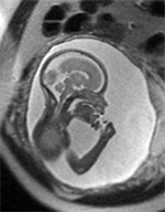 Fetal MRI