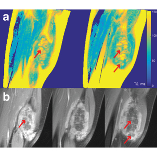 Comparison between T2 maps (a) and post-contrast images (b) for the same location for patient 2. The non-perfused volume (NPV) appears dark on the post-contrast images. Arrows show gaps in the NPV, which correspond to areas with low T2 in the T2 maps.