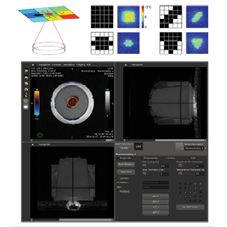 Examples of prescribed regions of treatment, and corresponding MR thermometry images, acquired during the heating.