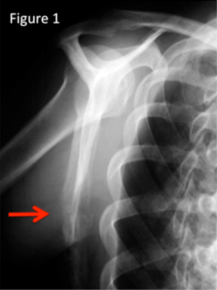 Figure 1 shows a painful bone metastasis (arrow) at the shoulder (scapula) caused by a testicular tumor. Bone Metastaes