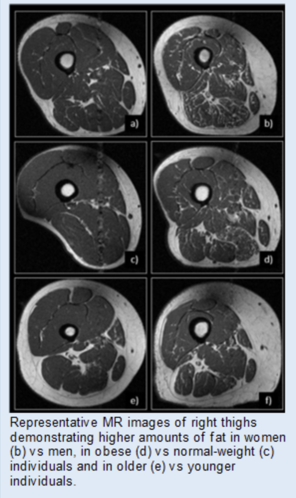 Images showing muscle volume and quality in osteoarthritis.