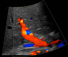 Doppler Ultrasound - UCSF Medical