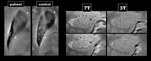 7 tesla MRI of hippocampus