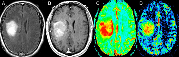 Brain Tumor Imaging GBM