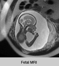 Fetal MRI - UCSF Medical