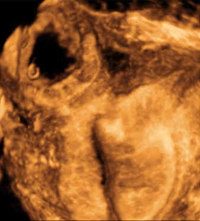 Ectopic Pregnancy Imaging 3D - UCSF Medical