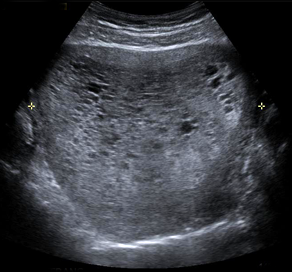 Pelvic Ultrasound - UCSF Medical