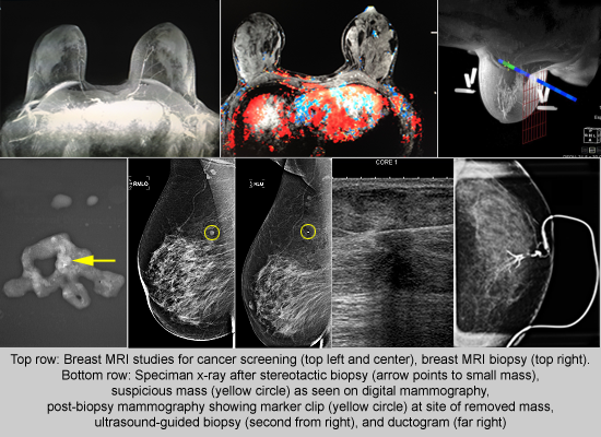 Mammograms - UCSF