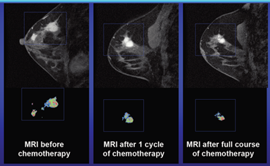 MRI During Treatment - UCSF Medical