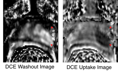 Dynamic Contrast Enhanced MRI