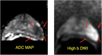 diffustion weighted imaging