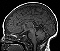  The Birth Asphyxia MRI (BAMRI) study 