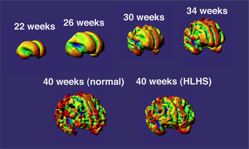 Cardiac MRI baby brain study