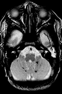 The Prematurely born neonate MRI (PreMRI)