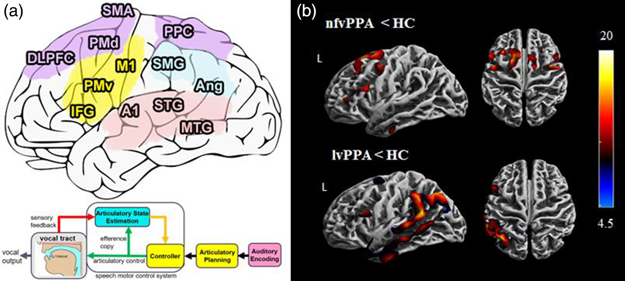 Theoretical framework linking speech repetition deficits in PPA to serial models of speech production and associated cortical atrophy.
