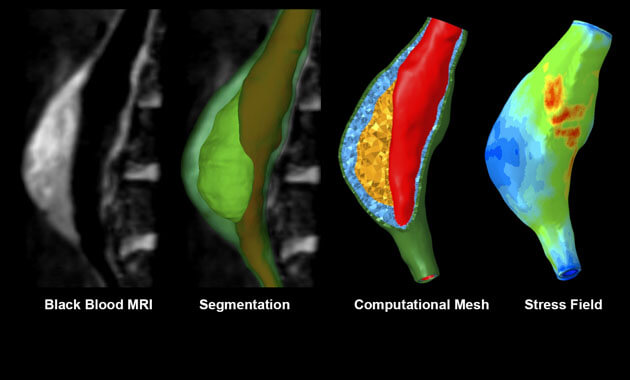 Computational mechanics modeling to predict abdominal aortic aneurysm stability - Joseph Leach, MD, PhD