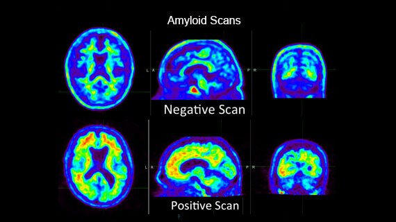 Amyloid PET scan for diagnosis