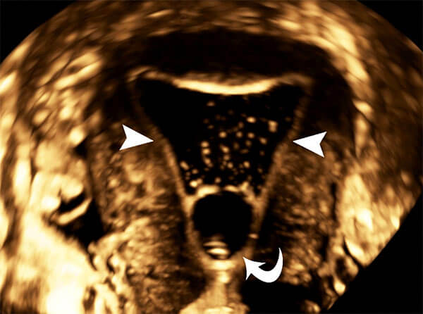 3D ultrasound hysterosonogram showing normal endometrial lining.
