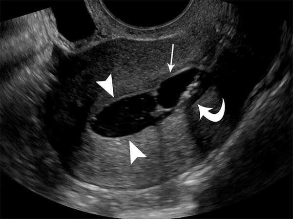 Normal ultrasound hysterosonogram showing normal endometrial lining.
