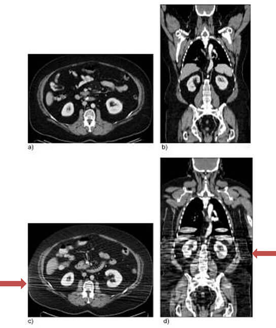 Axial and coronal CT images showing decreased image quality result from the improper positioning.