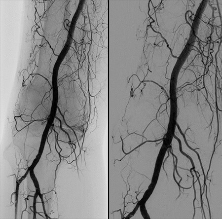 The left image shows a picture of the knee after injecting X-ray dye ("angiogram"). Abnormal vessels are seen surrounding the knee. The image on the right is the angiogram following embolization showing appropriate “pruning” of the abnormal vessels. 
