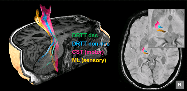 Brain imaging for planning HIFU treatments for essential tremor
