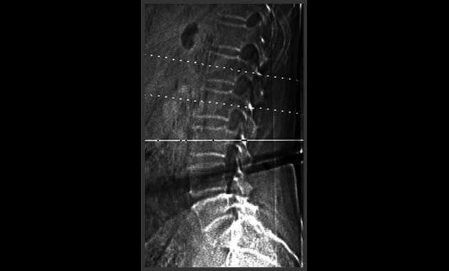Scout radiograph showing sections through the vertebral bodies which are used to measure the bone density. Radiograph also shows that all vertebral bodies are intact without fracture.