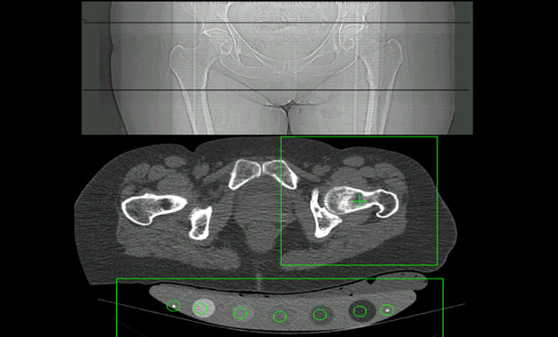 CT of the hip with a calibration phantom underneath the patient. From this image bone density of the hip is measured.