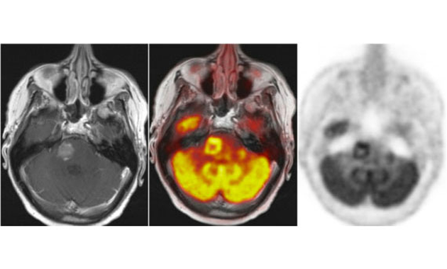 Brain Tumor using PET/MRI Scan