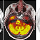 Brain Tumor using PET/MRI Scan