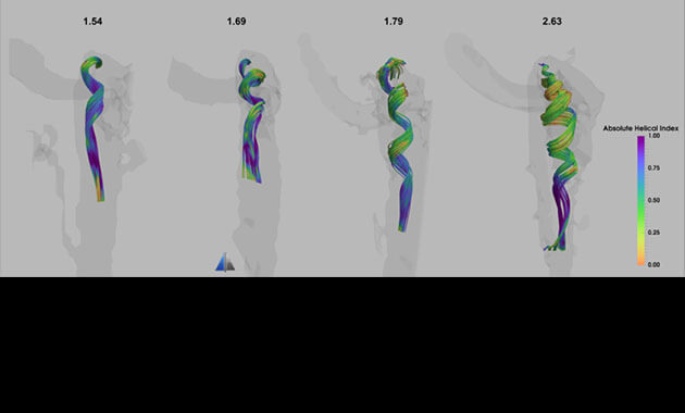Jugular Vein Flow Patterns in Patients with Pulsatile Tinnitus Using Computational Fluid Dynamics