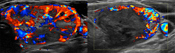 The left image is an ultrasound of a solid thyroid nodule with significant blood flow (colored blue and red). The right image is a repeat ultrasound after RFA showing a decrease in blood flow surrounding the nodule accompanied by a significant decrease in size.