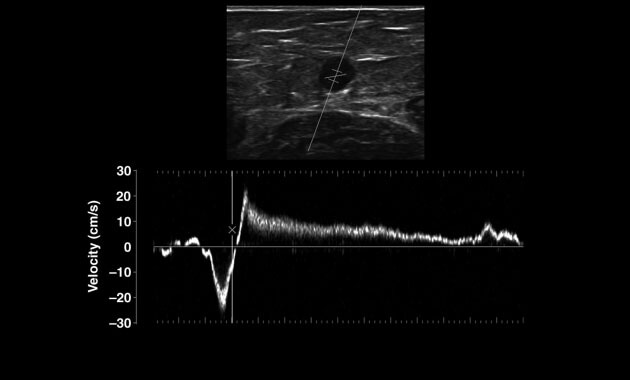Pulsed-wave Doppler image for Varicose Veins