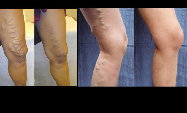 Before and after varicose veins treatment