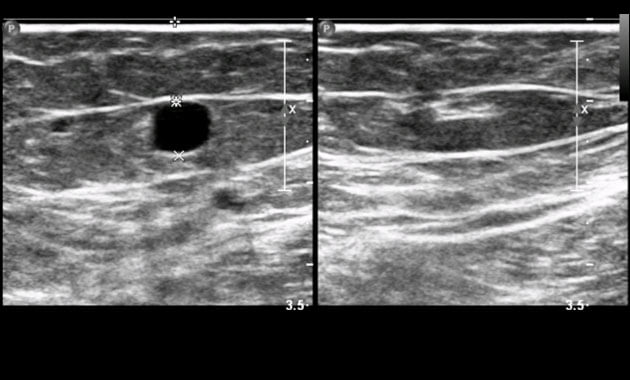 Ultrasound of abnormal vein