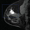 Breast MRI used to assess changes of chemotherapy
