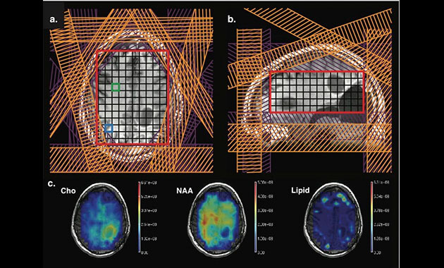 3D MRSI of brain tumor