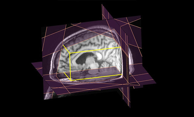 3D MRSI skull dataset