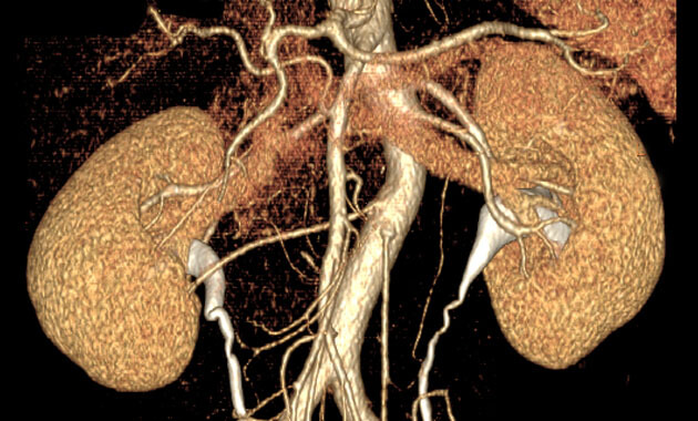 CT Angiogram