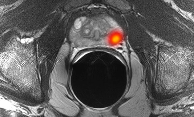 Multiparametric MR imaging of prostate cancer