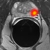 Multiparametric MR imaging of prostate cancer