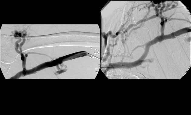 Occlusion of the left brachiocephalic vein with formation of extensive collateral vessels