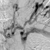 Thrombosis of the left brachiocephalic vein
