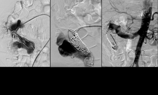Embolization of a large congenital arteriovenous malformation