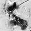 Embolization of a large congenital arteriovenous malformation