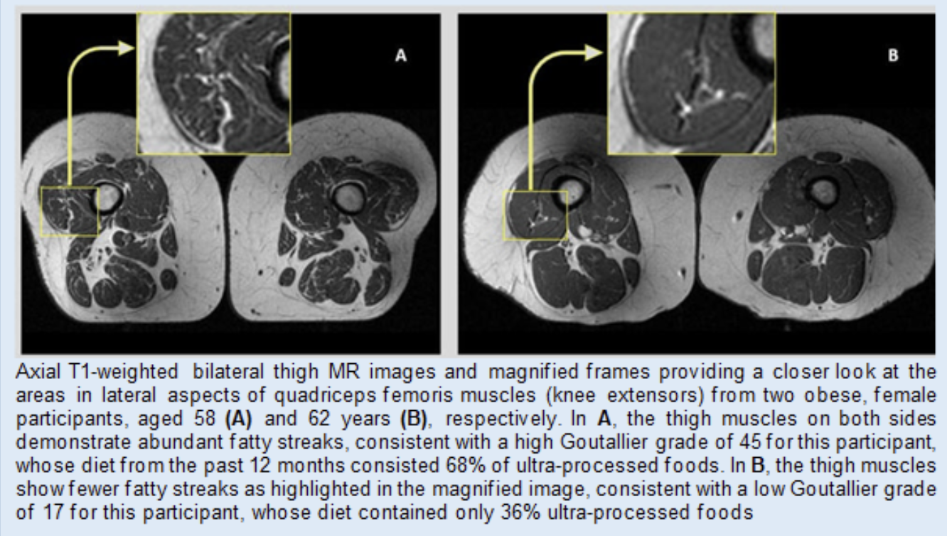 Scan showing variation in muscle tissue.